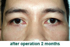 plastic-surgery-blepharoplasty